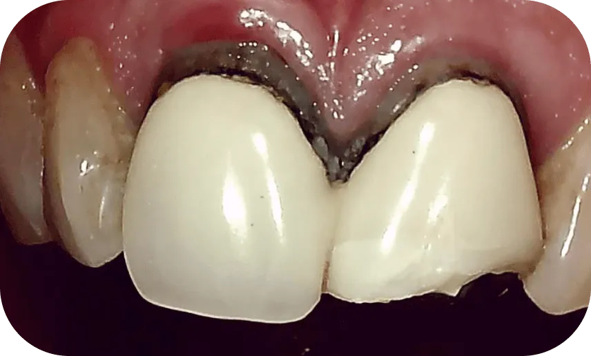 保険治療の症例