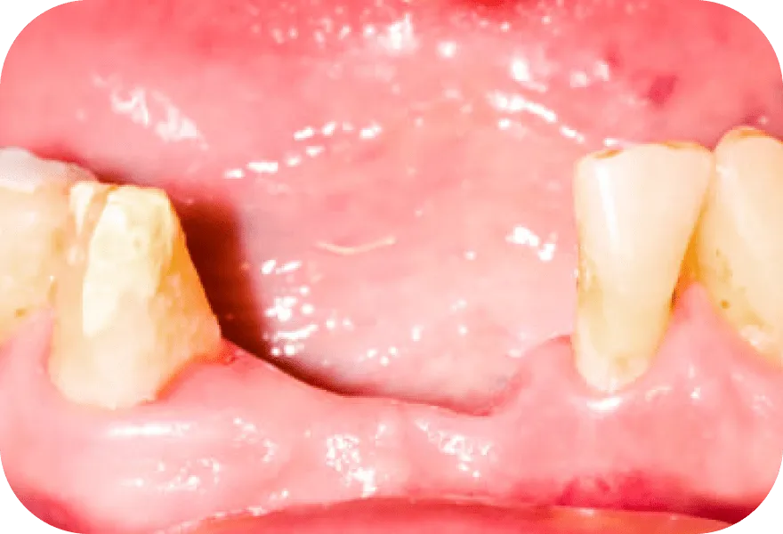 歯を失うリスクが高まる