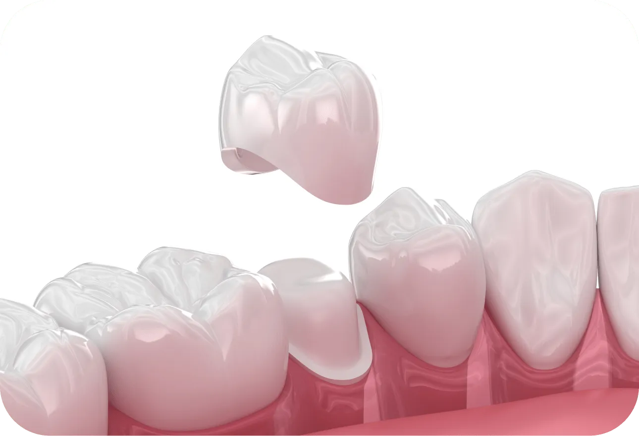 セラミック治療とは