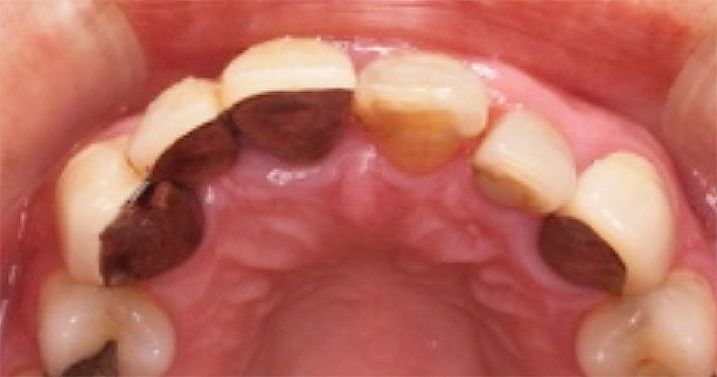前歯が虫歯になった 保険治療と自費治療 仕上がりはどうなる 本田歯科クリニック