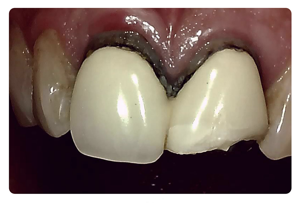 キラッと光る銀歯をなくしたい 自費治療のすすめ 本田歯科クリニック