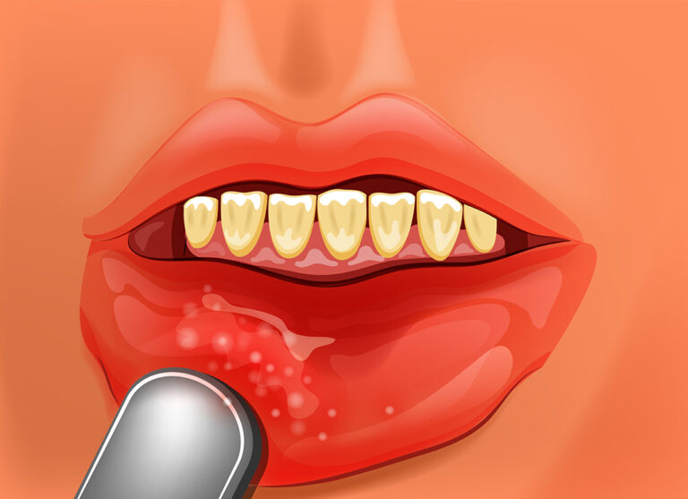 口内炎って知っていますか？