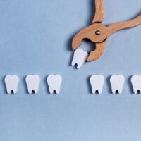 親知らずの抜歯が不安！？痛みや抜歯方法、その後のケアについて